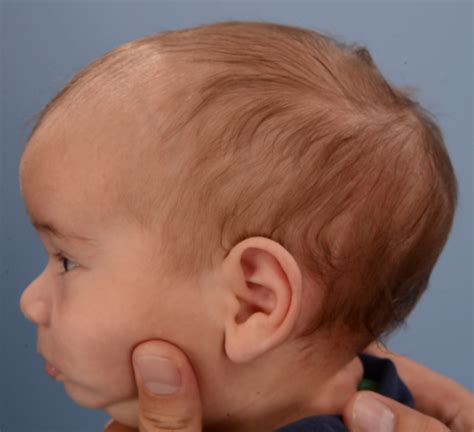 abnormal head shape baby.